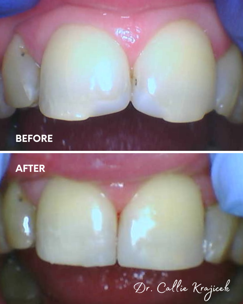 Dental Bonding before and after done by Dr. Callie Krajicek