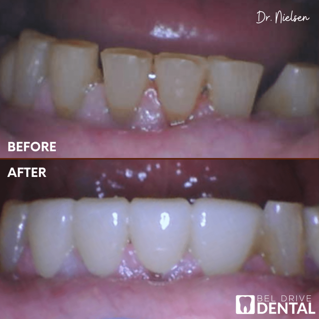 Dental crowns before and after done by Dr. Nielsen