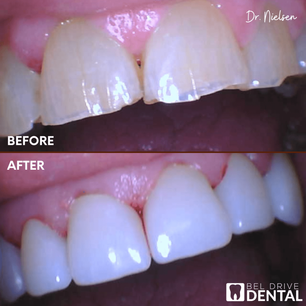 Dental crowns before and after done by Dr. Nielsen
