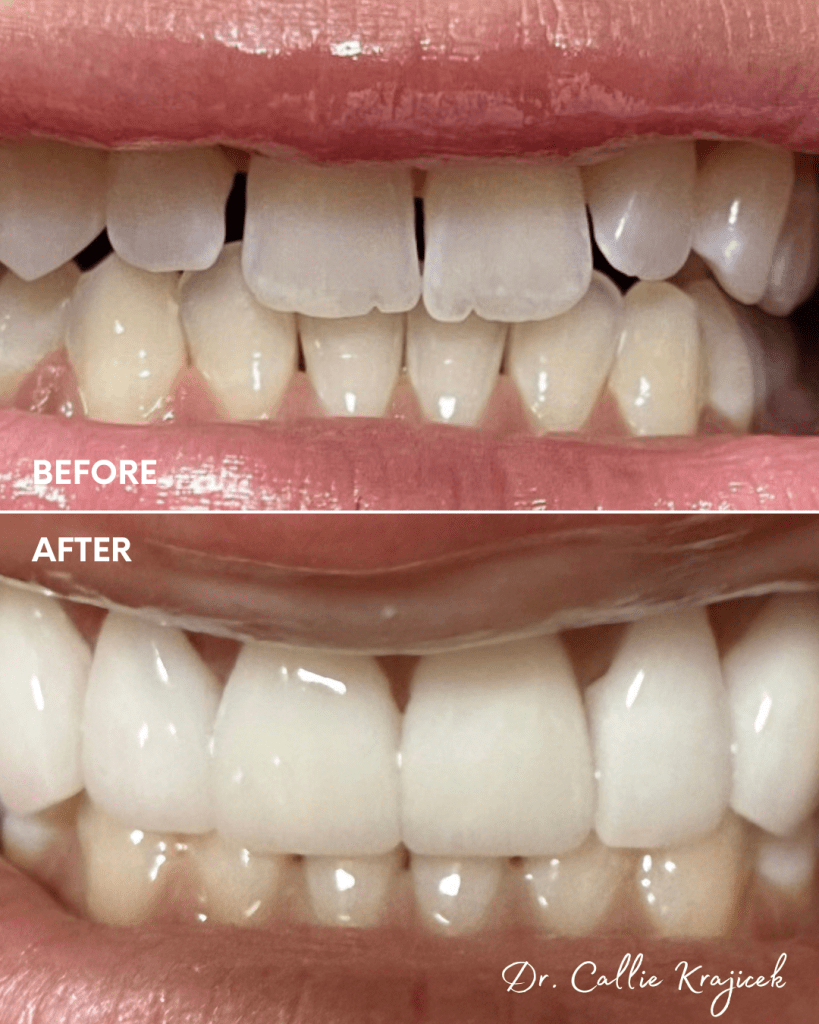 Veneers before and after done by Dr. Callie Krajicek