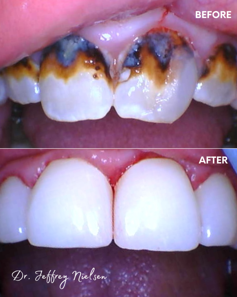 Dental crowns and buccal composites before and after done by Dr. Nielsen