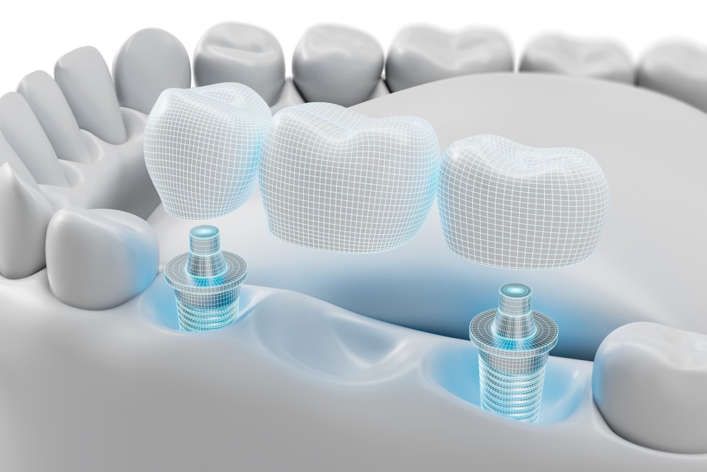 dental implant bridge structure