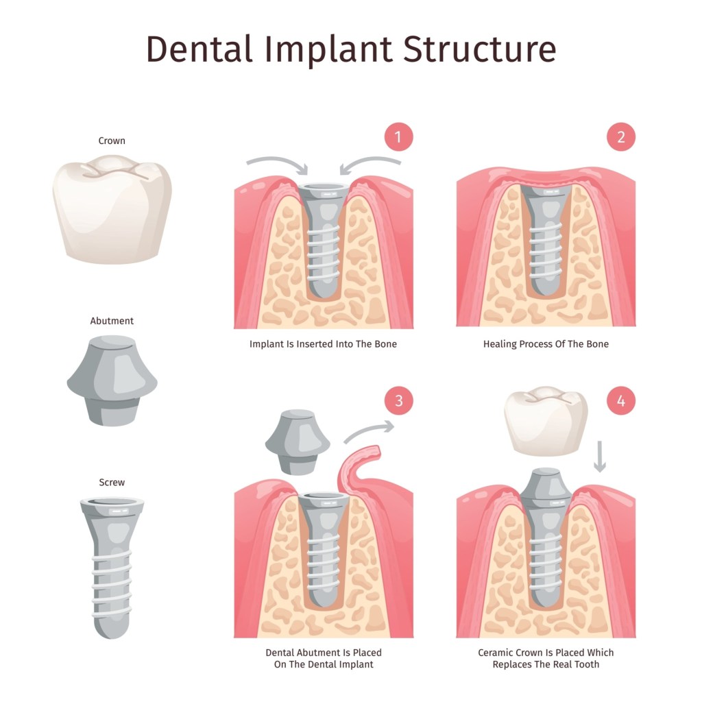 dental implant structure tooth implantation procedure