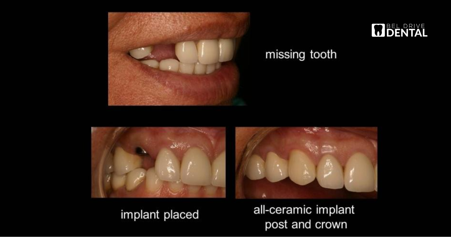 Process of a single tooth replacement at Bel Drive Dental.