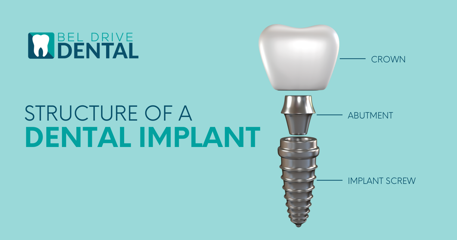 Breakdown of the structure of a dental implant used to help replace missing teeth.