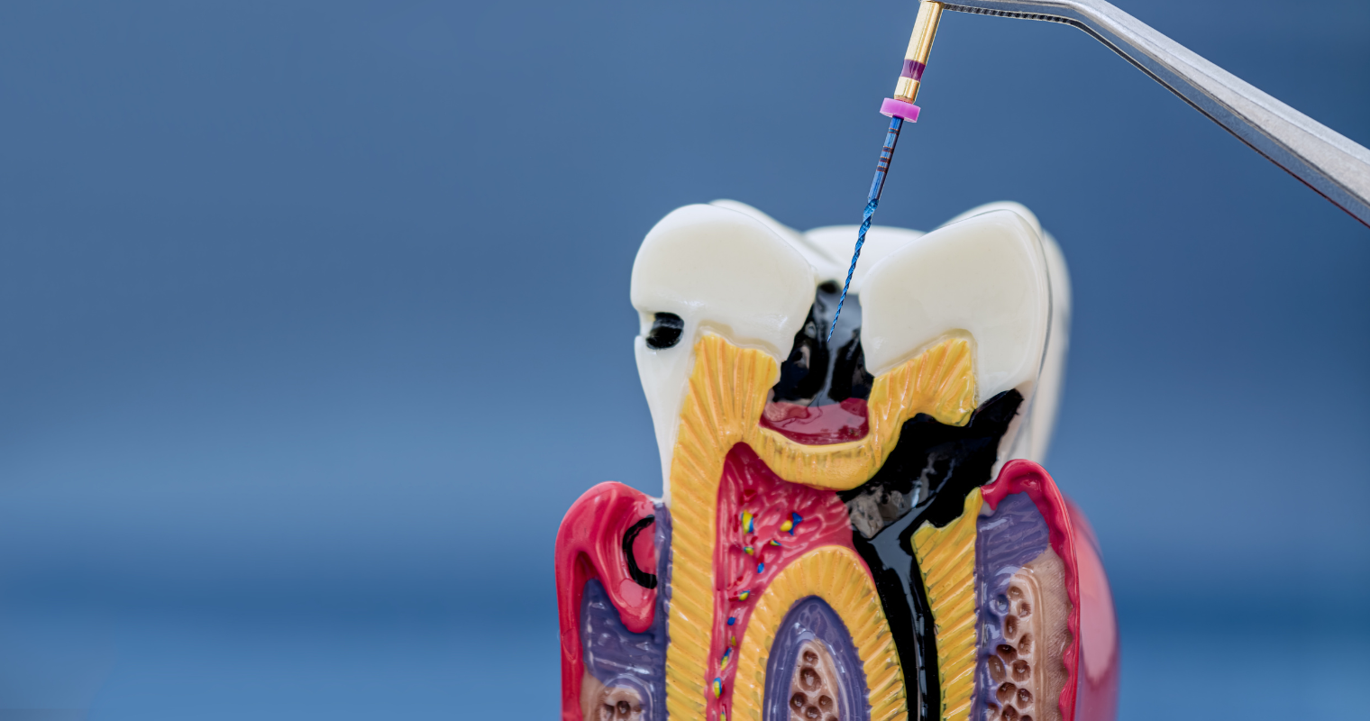 Root canals can save your natural teeth and prevent the need of dental implants or bridges.